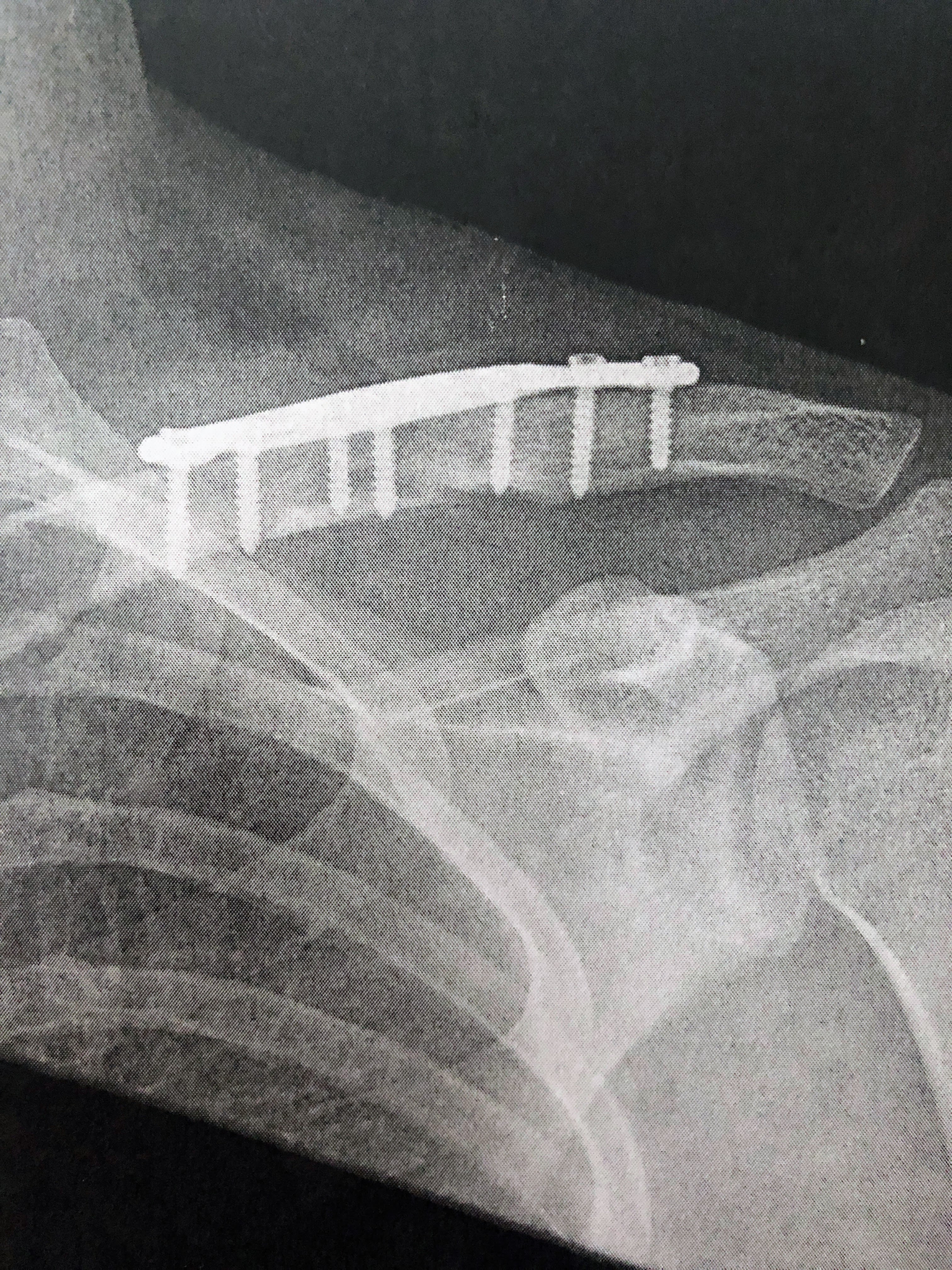 Collar Bone Repair